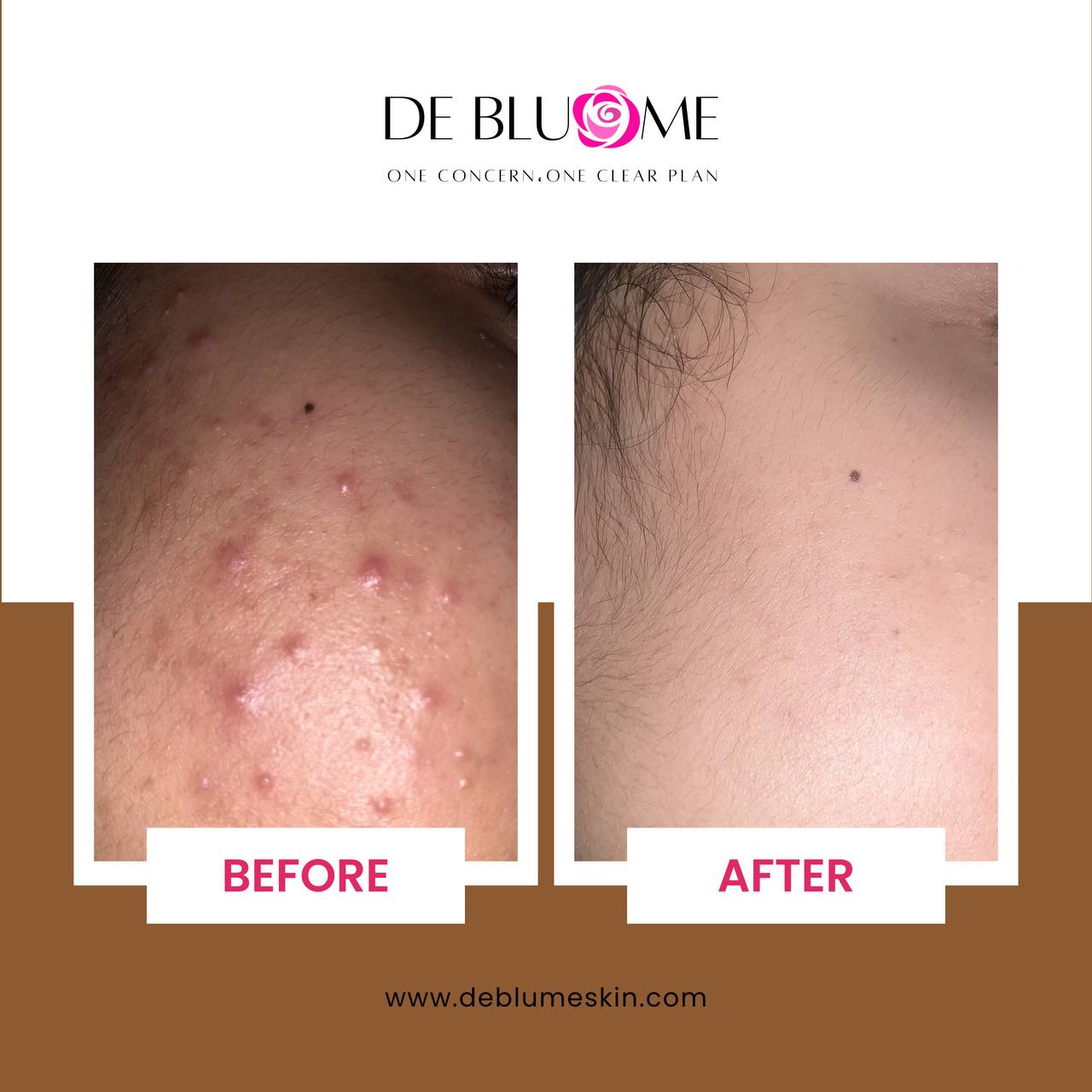 No-Acne Toner 100 ml