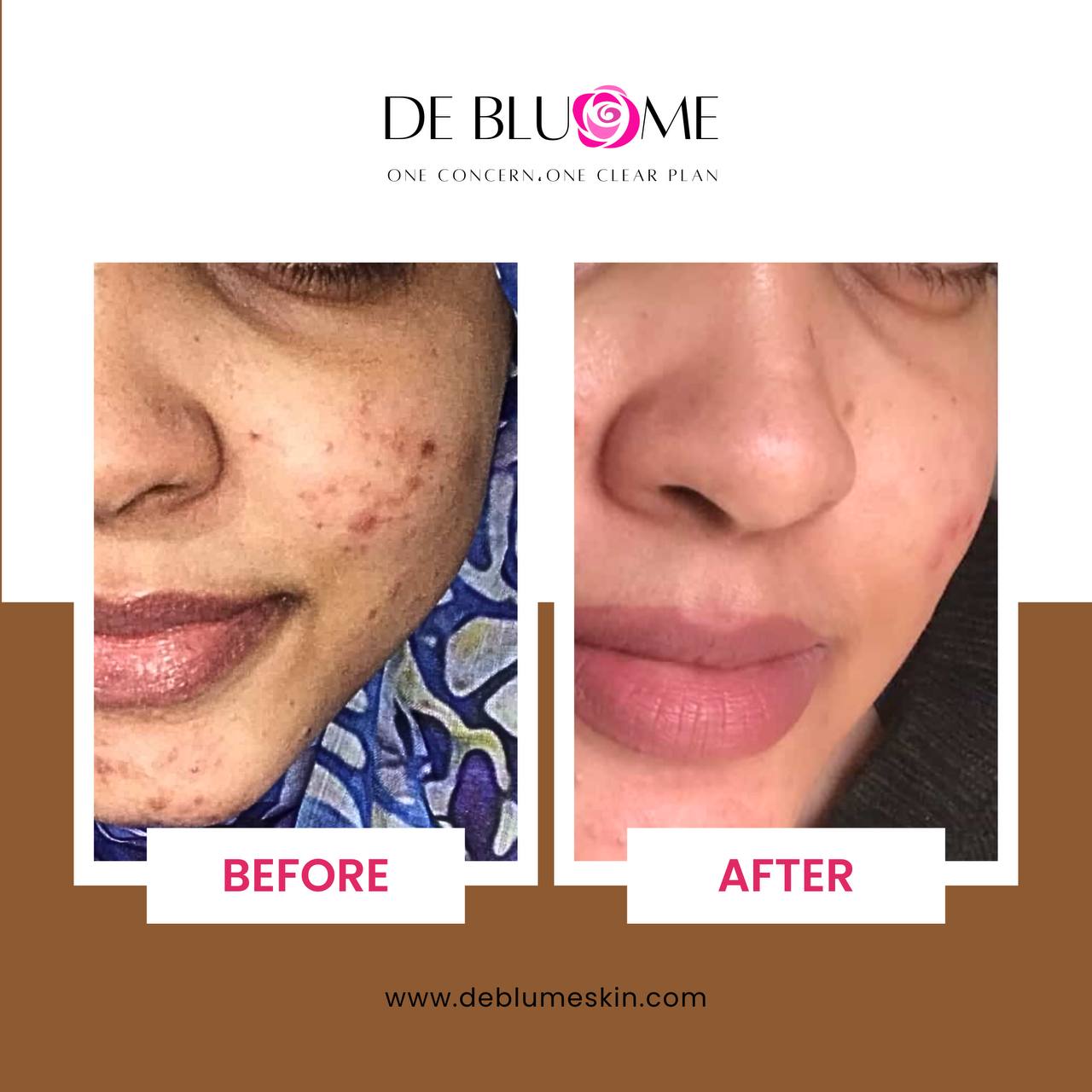 No-Acne Package