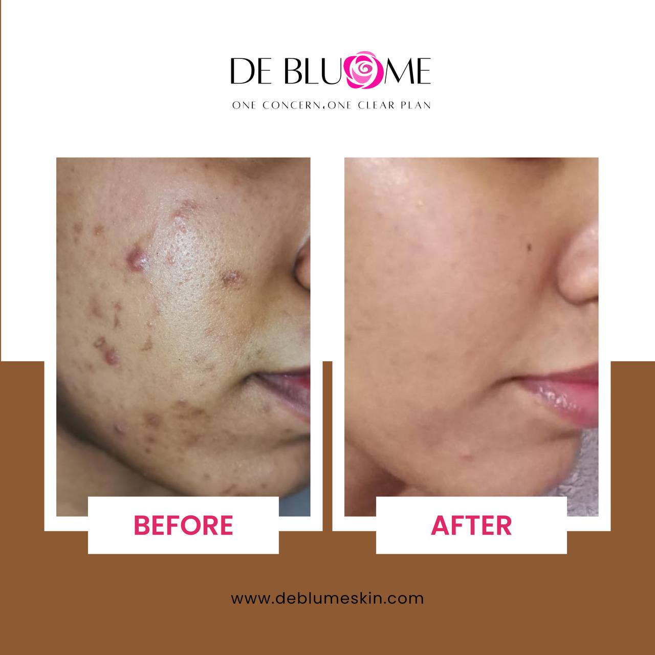 No-Acne Serum 30 ml