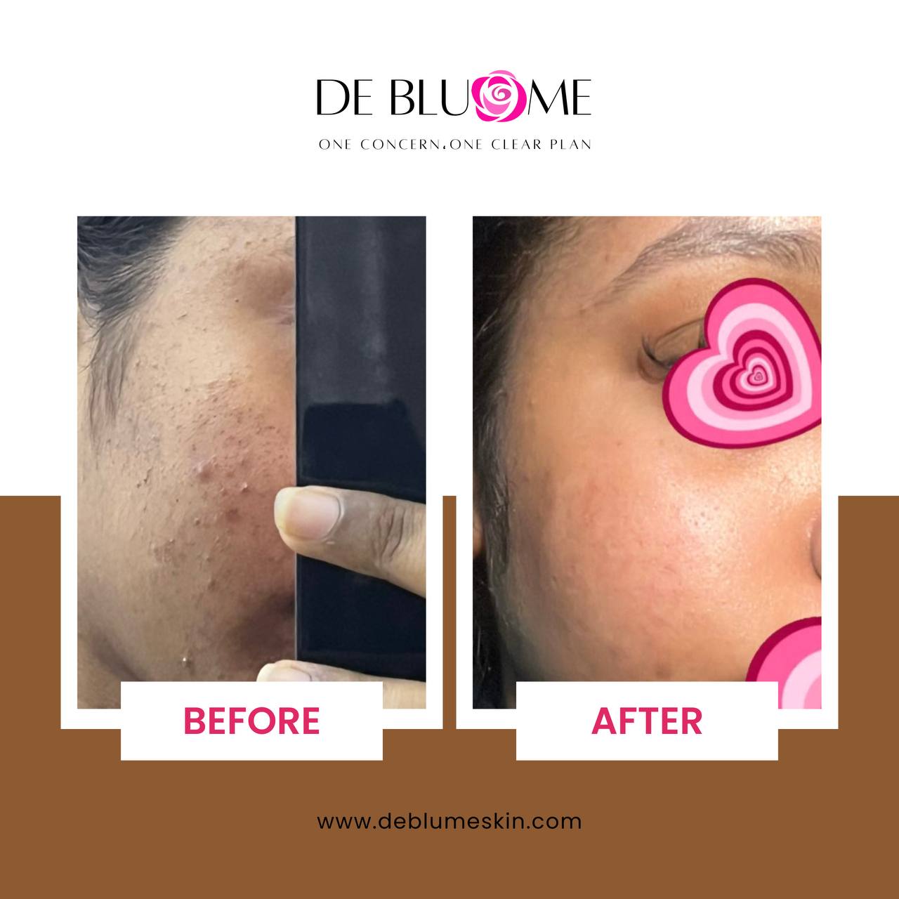 No-Acne Wash 150 ml